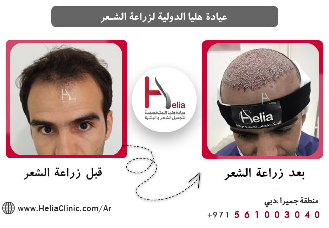 تكلفة زراعة الشعر في عيادة هليا دبي