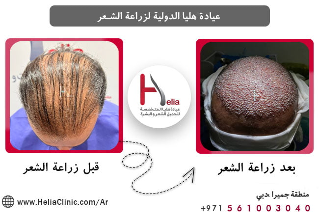 تكلفة زراعة الشعر في الإمارات