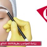 زراعة الحواجب بطريقة SUT - النتائج والمتانة