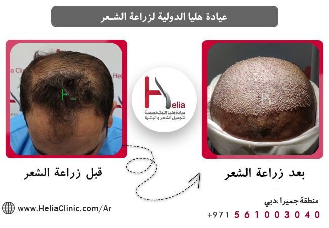 أفضل الدكتور والعيادة لزراعة الشعر بطريقة الشريحة FUT
