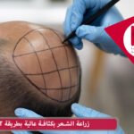 زراعة الشعر بكثافة عالية بطريقة FIT