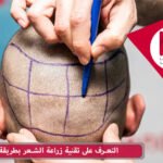 مقدمة عن تقنية الشريحة FUT لزراعة الشعر