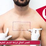 زراعة الشعر باستخدام شعر الجسم