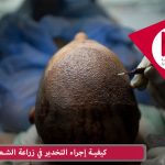 كيفية إجراء التخدير في زراعة الشعر
