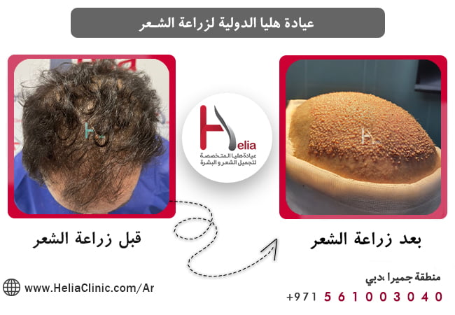 ما هو أصل التخدیر الرأس بعد زراعة الشعر