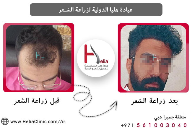 علاج تساقط الشعر في مقدمة الرأس