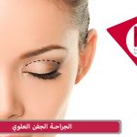الجراحة الجفن العلوي