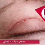 اضرار عملية شد الجفون