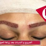 الجروح و الندبات بعد زراعة الحواجب