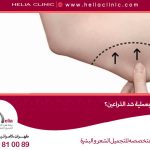 ما المقصود بعملية شد الذراعين؟