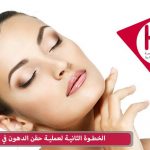 الخطوة الثانية لعملية حقن الدهون في الوجه