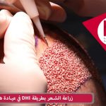 زراعة الشعر بطريقة DHI  في عيادة هليا