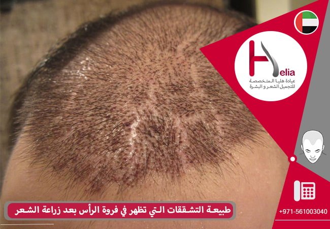 طبيعة التشققات التي تظهر في فروة الرأس بعد زراعة الشعر