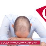 مضاعفات و مخاطر زراعة الشعر