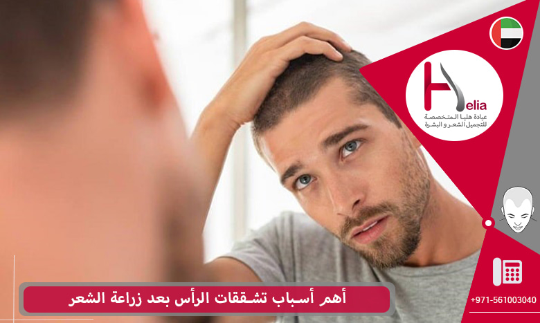 أهم أسباب تشققات الرأس بعد زراعة الشعر