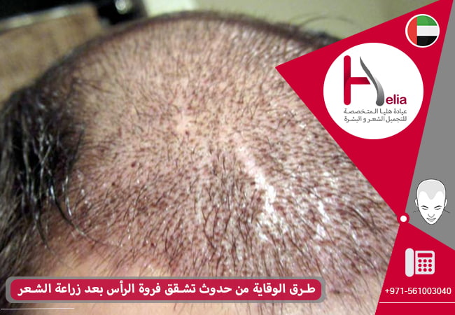 طرق الوقاية من حدوث تشقق فروة الرأس بعد زراعة الشعر