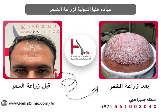زراعة الشعر بتقنية DHI هي أحدث طريقة في دبي
