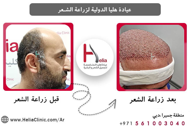 أمثلة على عمليات زراعة الشعر (3)