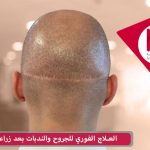 العلاج الفوري للجروح والندبات بعد زراعة الشعر