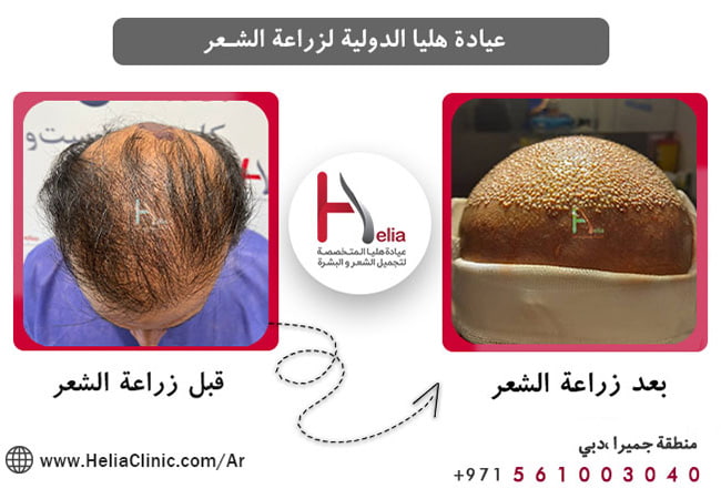 نصائح لإجراء عمليات زراعة الشعر بكثافة عالية در في الإمارات
