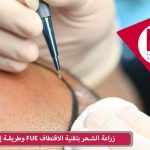 زراعة الشعر بتقنية الاقتطاف FUE