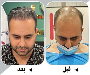 خبرة في زراعة الشعر في عيادة هليا في الإمارات