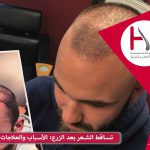 تساقط الشعر بعد الزرع: الأسباب والعلاجات الممكنة