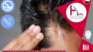 العوامل المؤثرة في نجاح وفشل زراعة الشعر