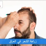 زراعة الشعر في العراق