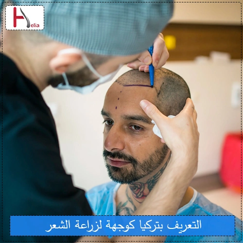 التعريف تركيا كوجهة لزراعة الشعر