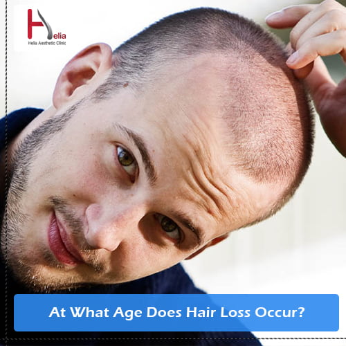 At What Age Does Hair Loss Occur?
