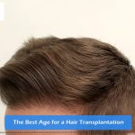 The Best Age for a Hair Transplantation