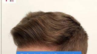 The Best Age for a Hair Transplantation