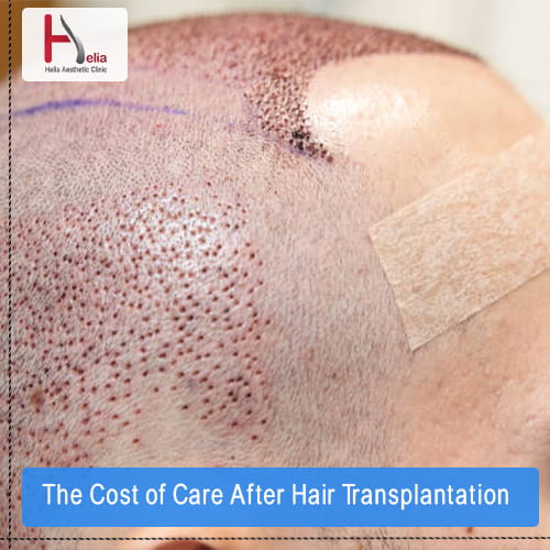 The Cost of Care After Hair Transplantation