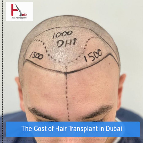 The Cost of Hair Transplant in Dubai