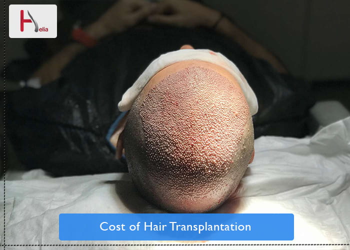 Cost of Hair Transplantation in Dubai [2023]