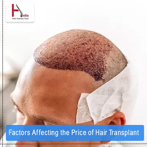 Factors Affecting the Price of Hair Transplant