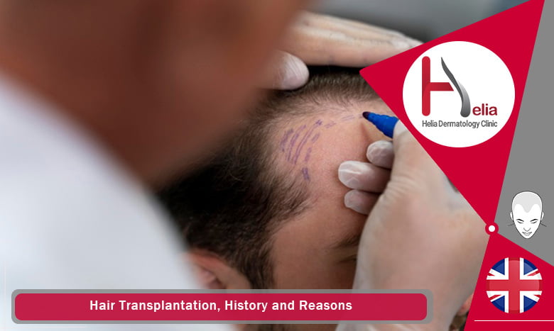 Hair Transplantation, History and Reasons