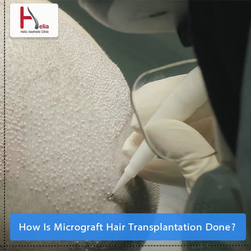 How Is Micrograft Hair Transplantation Done?