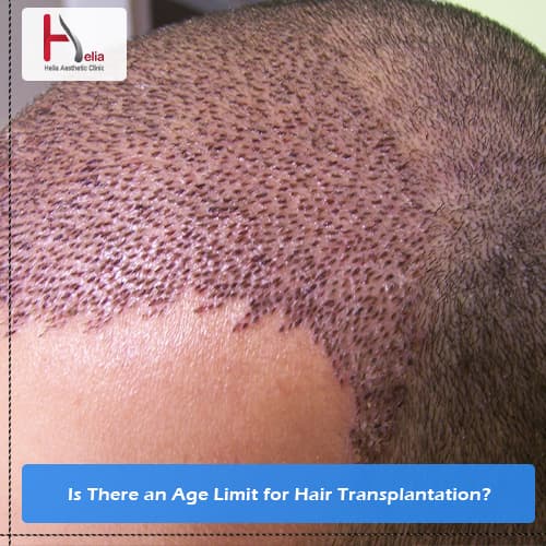 Is There an Age Limit for Hair Transplantation?
