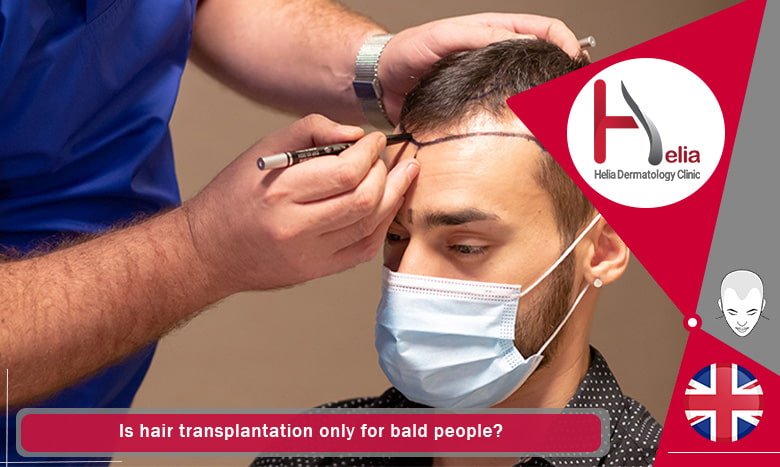 Is hair transplantation only for bald people