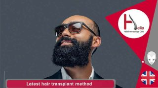 Latest hair transplant method