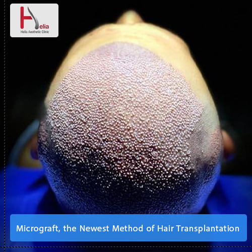 Micrograft, the Newest Method of Hair Transplantation