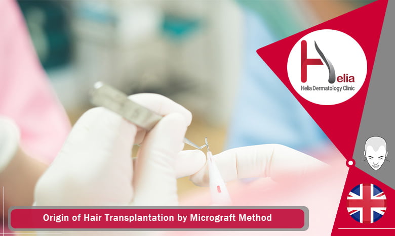 Origin of Hair Transplantation by Micrograft Method