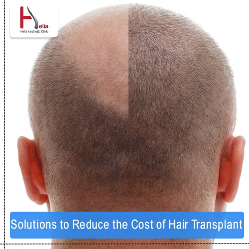 Solutions to Reduce the Cost of Hair Transplant