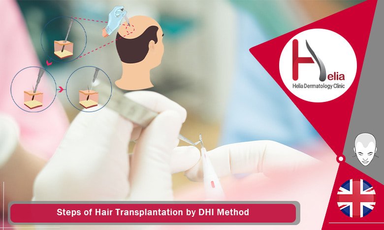 Steps of Hair Transplantation by DHI Method