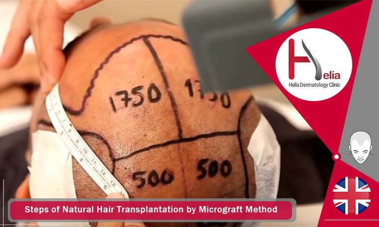 Steps of Natural Hair Transplantation by Micrograft Method