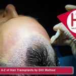 The A-Z of Hair Transplants by DHI Method