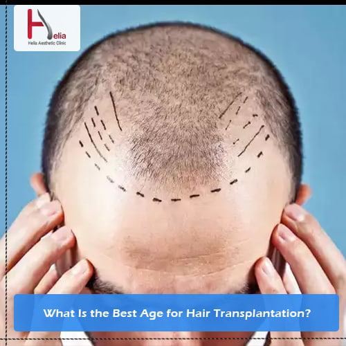 What Is the Best Age for Hair Transplantation?