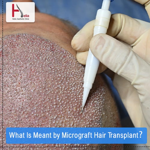 What Is Meant by Micrograft Hair Transplant?